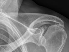 Röntgenfoto van de schouder.