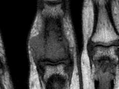 MRI-scan van de ringvinger.