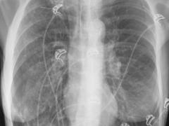 Röntgenfoto van een ribbenkast. 