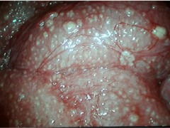 Voorbeeld van het sterrenhemelaspect tijdens een laparoscopie, een diffuus beeld van een peritonitis met verspreid in het abdomen multipele witgele spikkels.