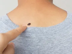 Een vinger die wijst naar een moedervlek 