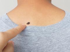 Een vinger die wijst naar een moedervlek 