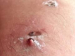 Been met een uitstekende larve