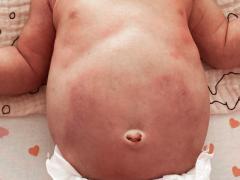 Baby met gezwollen en rode buik