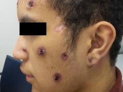 Patiënt met pustels