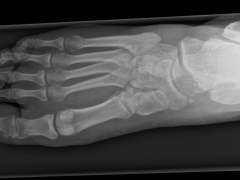 Röntgen van voet