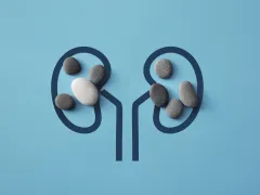 Illustratie van nieren met stenen erin