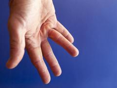 Hand met symptomen van ziekte van Dupuytren