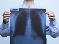 Een man die een röntgenfoto van zijn borst voor zijn borst houdt