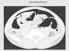 Post-mortem-CT-scan