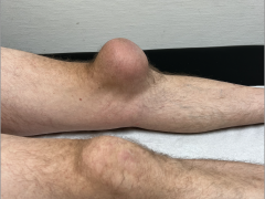 Gezwollen linkerknie