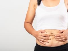 Vrouw die haar handen op een buik met litteken houdt