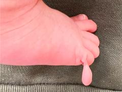 Extra teentje van patiënt B