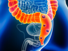 Illustratie van de darm met tumoren bij het rectum