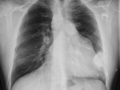 Röntgenbeeld van de borstkas