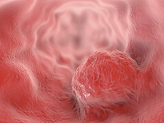 Tumor in de slokdarm