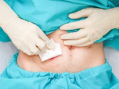 Stoma die verwijderd is