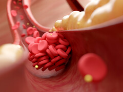 Illustratie van een vernauwde slagader door plaque