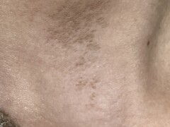 Verkleuring in de hals