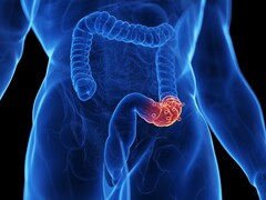 Illustratie van een afwijking in de dikke darm