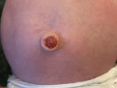 Babybuik met navelgranuloom