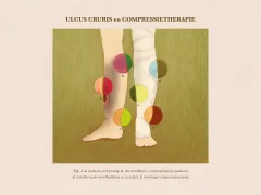 Illustratie van ulcus cruris