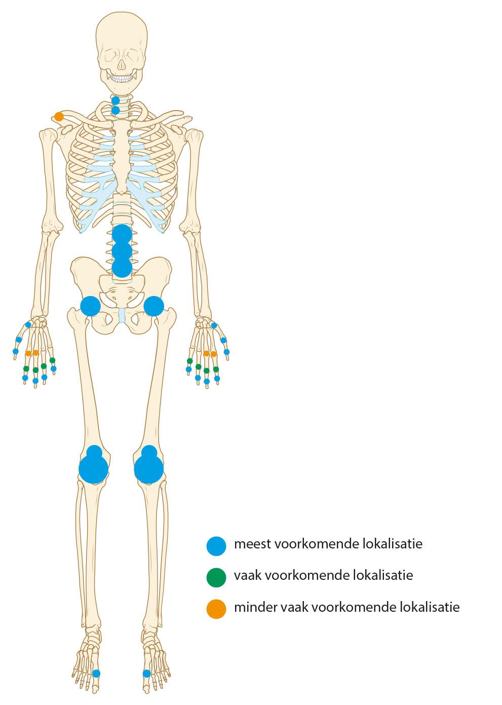 Figuur 1 | Lokalisaties van artrose