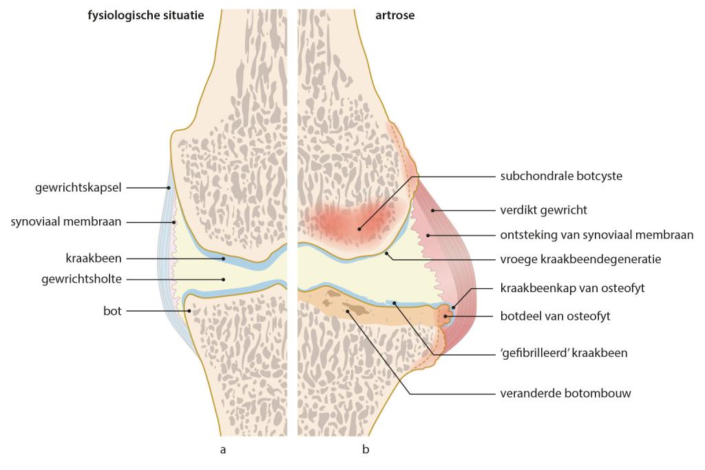 Figuur 3 | Schematische weergave van het kniegewricht | (a) In de fysiologische situatie en (b) bij artrose