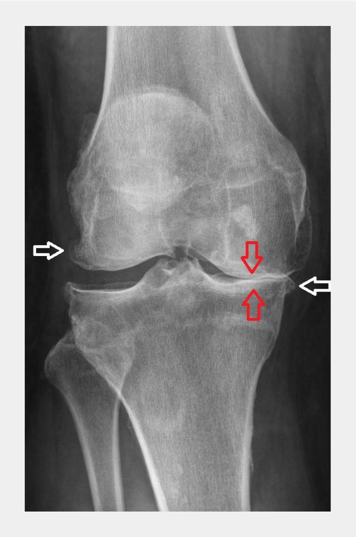 Figuur 4 | Anterieur-posterieure röntgenopname van rechter knie met gonartrose