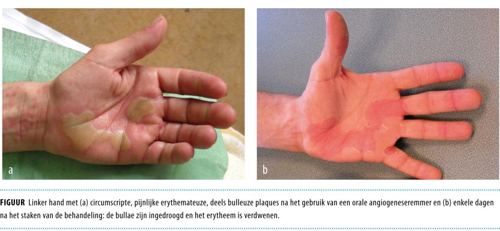 Een man met blaren op handen en voeten | NTvG