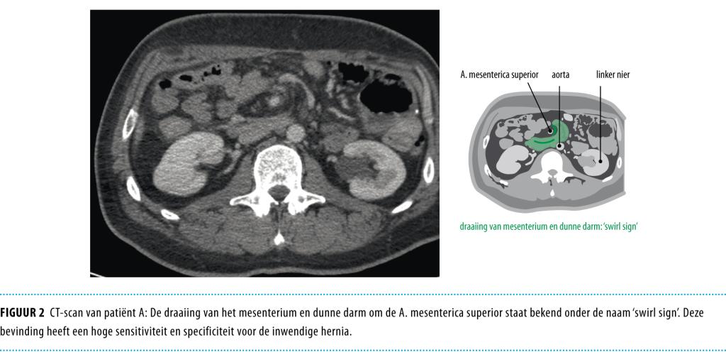 Inwendige herniatie na laparoscopische maagbypass | NTVG