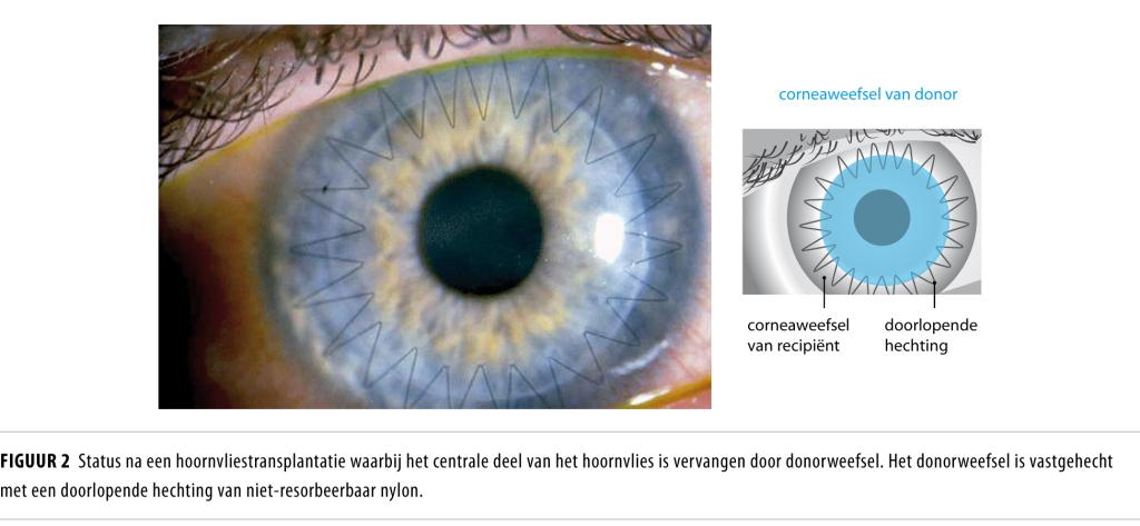 Ontwikkelingen in corneatransplantatie | NTvG
