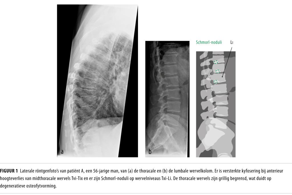 Osteoporotische wervelfracturen of ziekte van Scheuermann? NTvG
