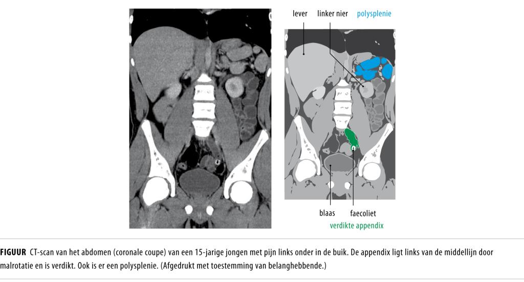 Een jongen met pijn links onder in de buik NTvG