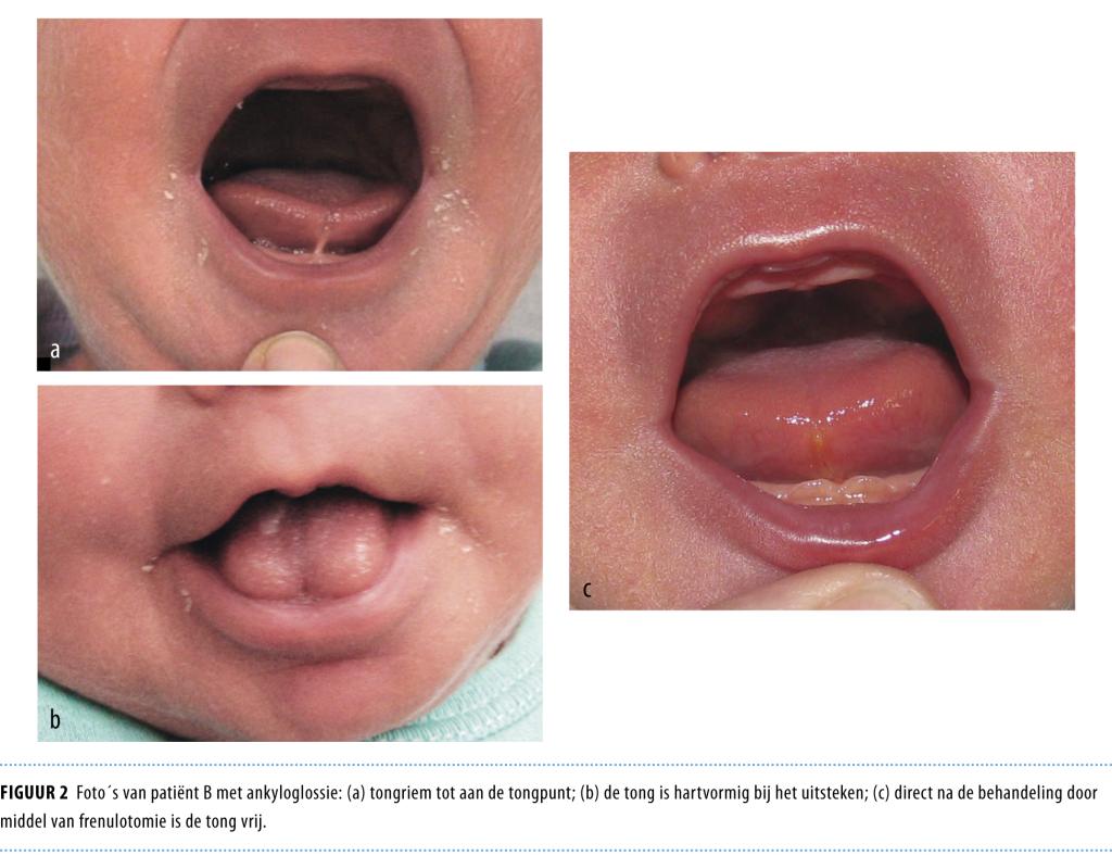 Problematische borstvoeding door een te korte tongriem NTvG