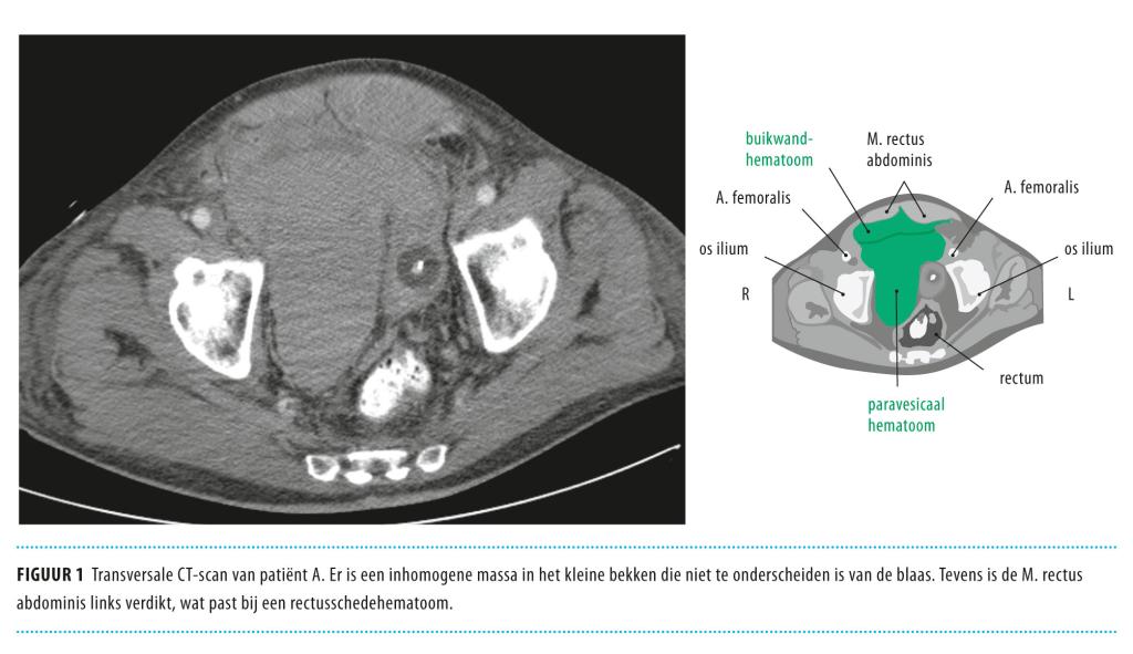 Urologische symptomen bij het rectusschedehematoom NTvG