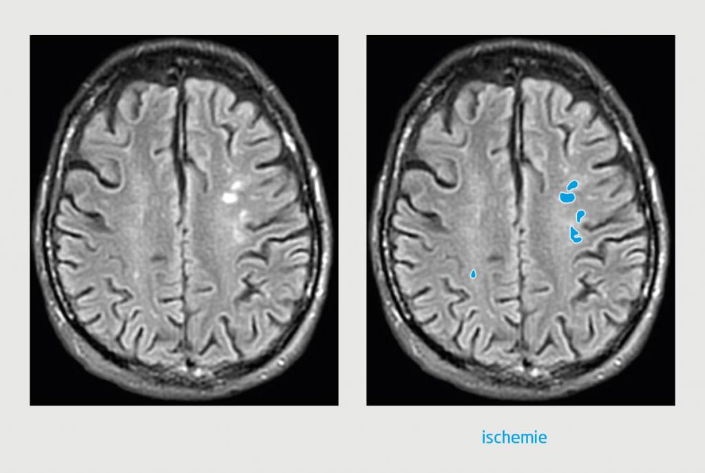 Figuur 1 | MRI-opname van het cerebrum van patiënt A
