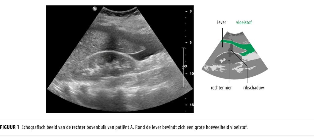 Een patiënt met hoog creatinine maar zonder nierfalen | NTvG