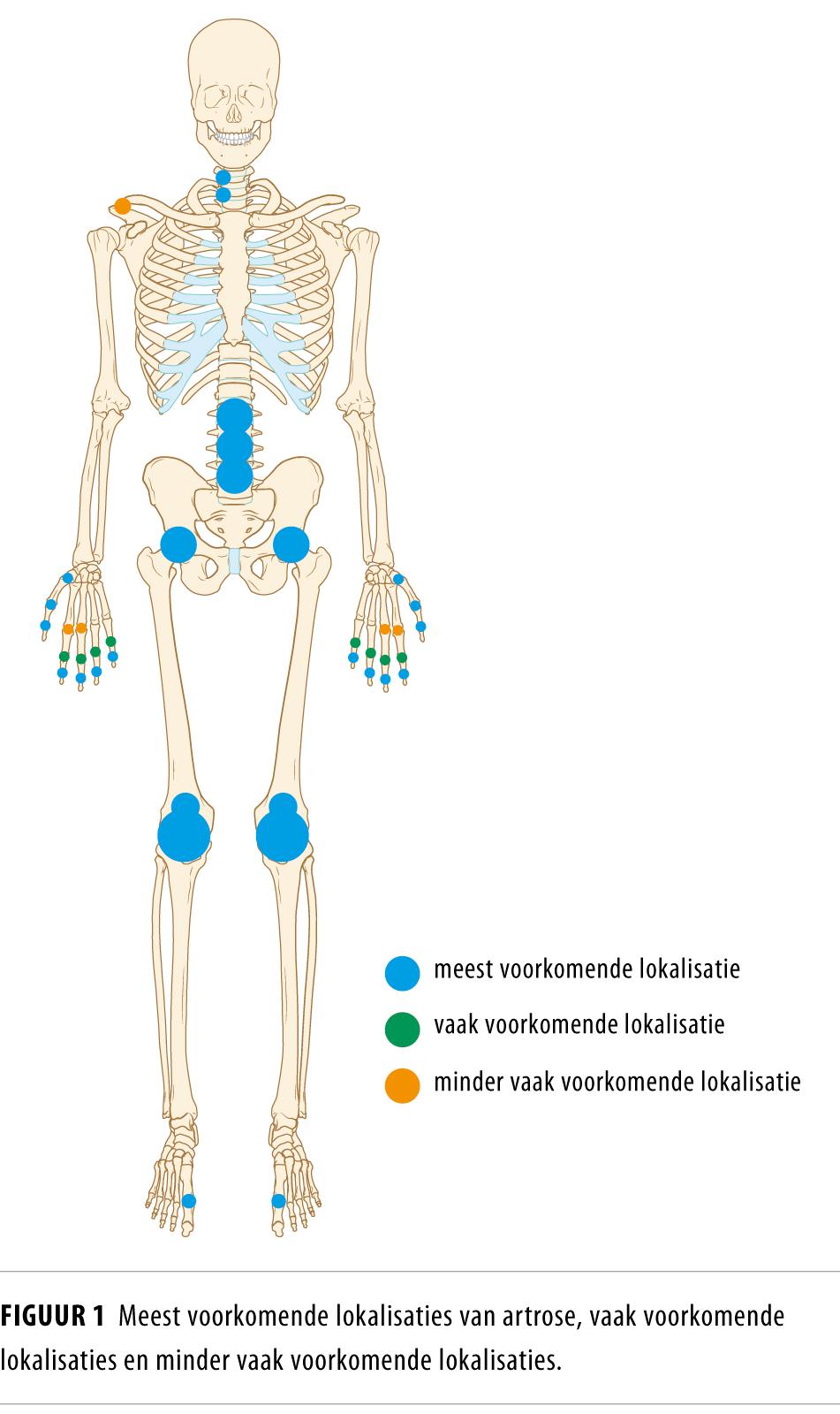 Figuur 1 | Lokalisaties van artrose | Meest voorkomende, vaak voorkomende en minder vaak voorkomende lokalisaties