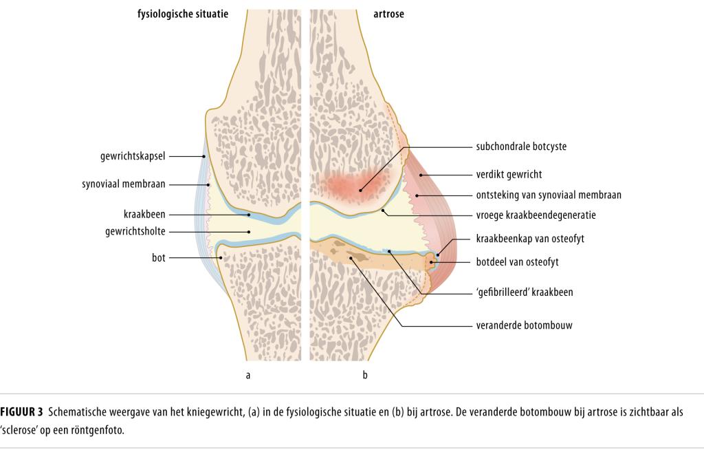 Figuur 3 | Schematische weergave van het kniegewricht | (a) In de fysiologische situatie en (b) bij artrose