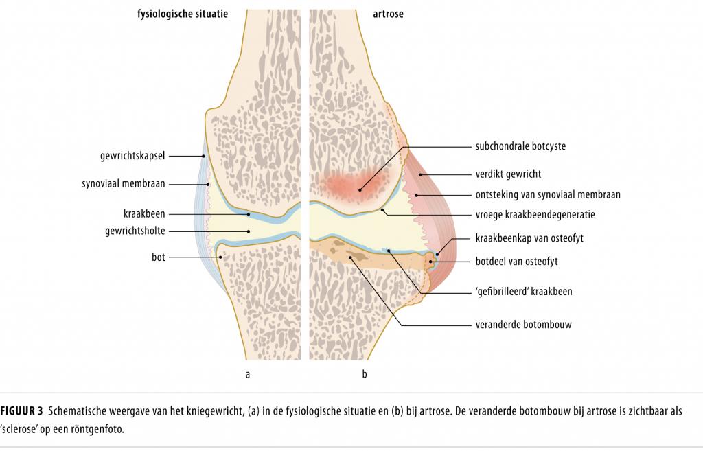 Figuur 3 | Schematische weergave van het kniegewricht | (a) In de fysiologische situatie en (b) bij artrose