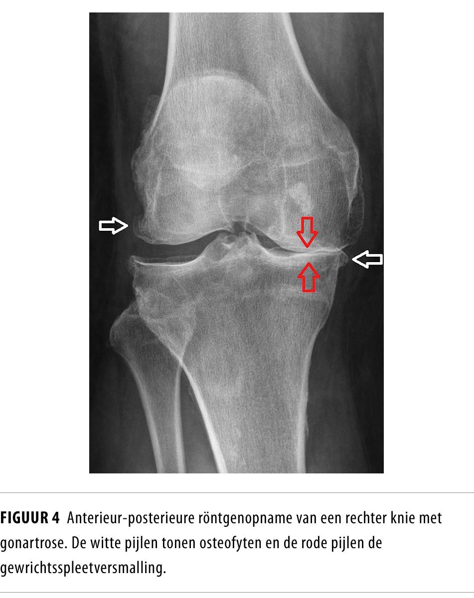 Figuur 4 | Anterieur-posterieure röntgenopname van rechter knie met gonartrose