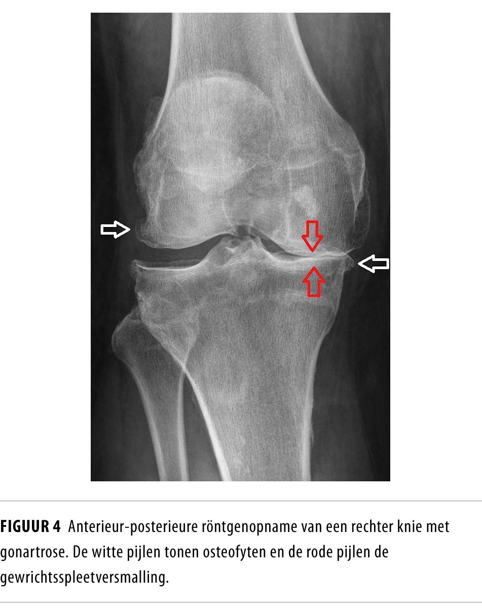 Figuur 4 | Anterieur-posterieure röntgenopname van rechter knie met gonartrose