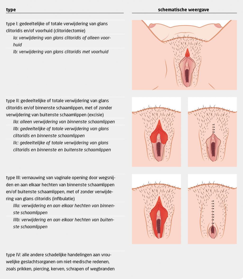 Tabel 1 | Typen vrouwelijke genitale verminking volgens WHO