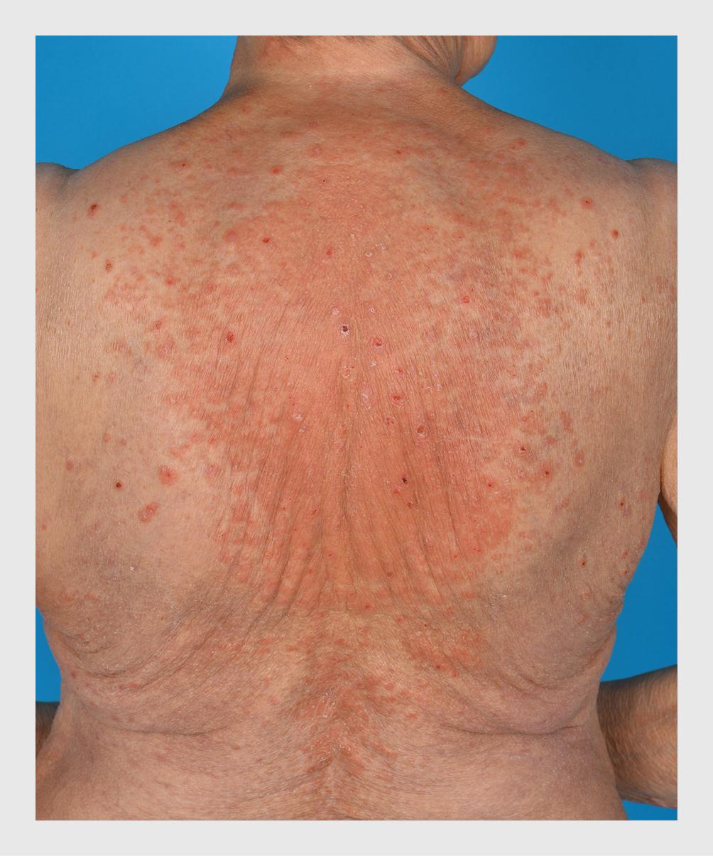 Figuur 1 | Jeukende, eczemateuze huidafwijkingen bij de non-bulleuze vorm van pemfigoïd