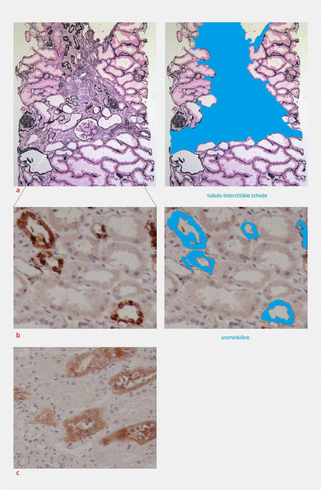Figuur 1 | Nierschade door uromoduline-ophoping bij MCKD type 2