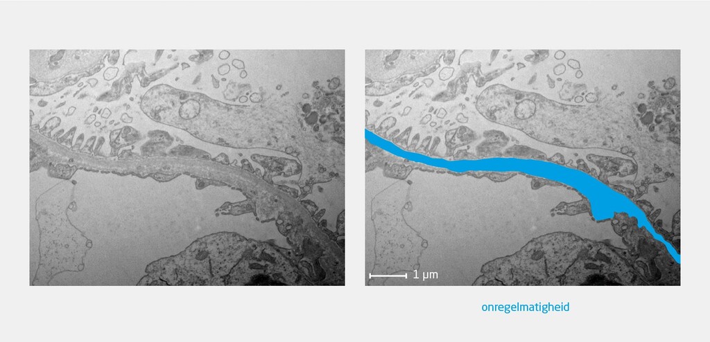Figuur 2 | Glomerulopathie bij patiënt met vermoeden van syndroom van Alport