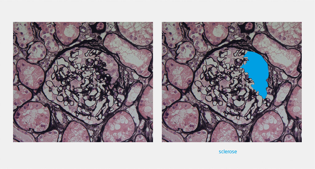 Figuur 3 | Glomerulaire sclerose bij FSGS