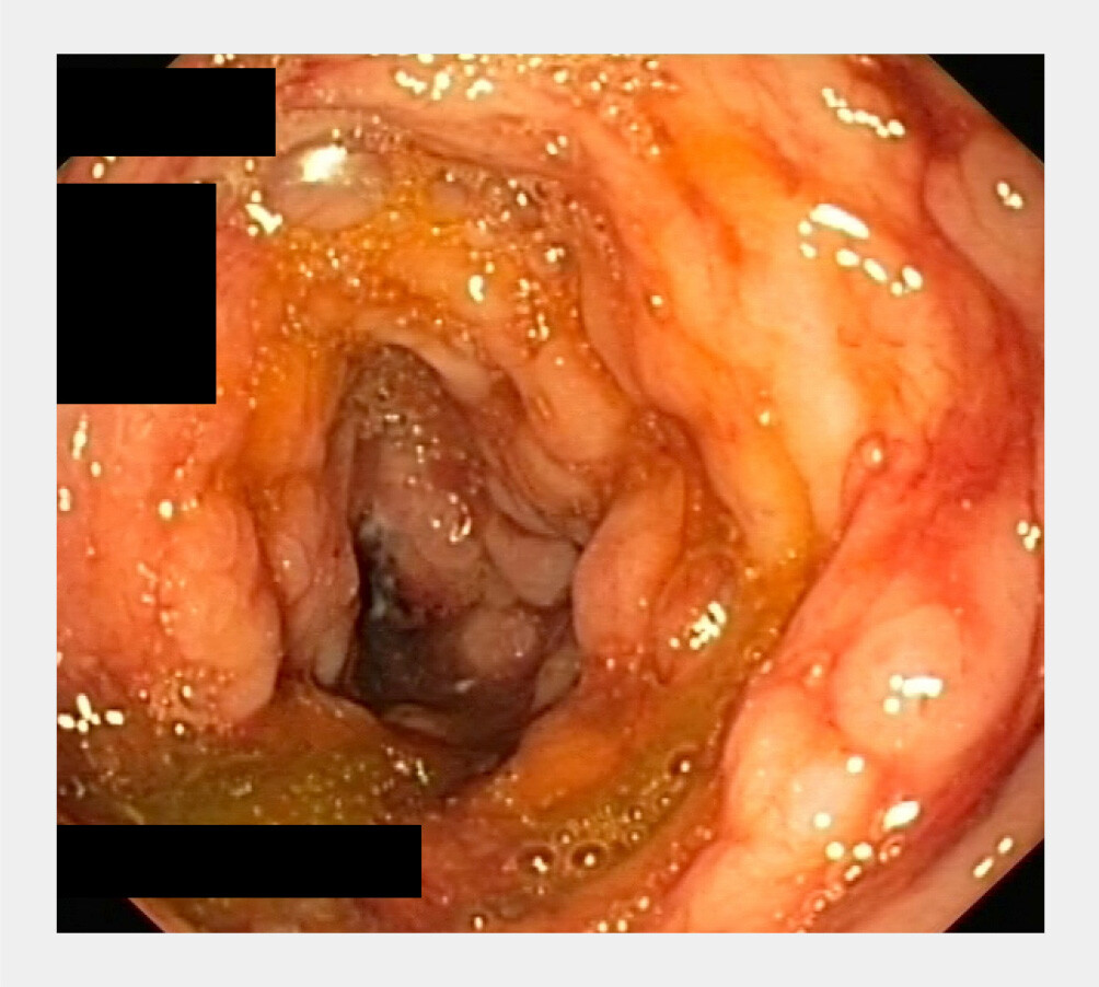 Figuur 1 | Ulceraties in het colon bij patiënt A