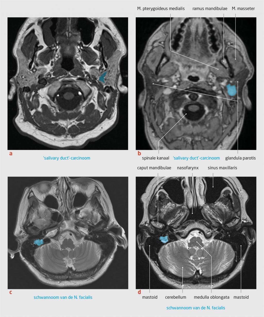 Figuur 1 | Oorzaken van facialisparese bij patiënt B en C | Axiale MRI-opnames